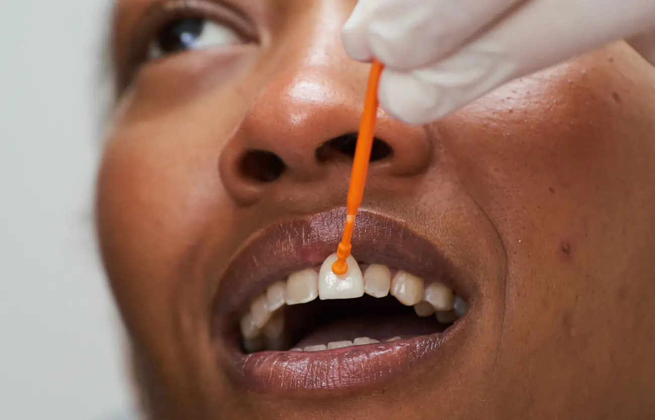 Veneers Behandlung
