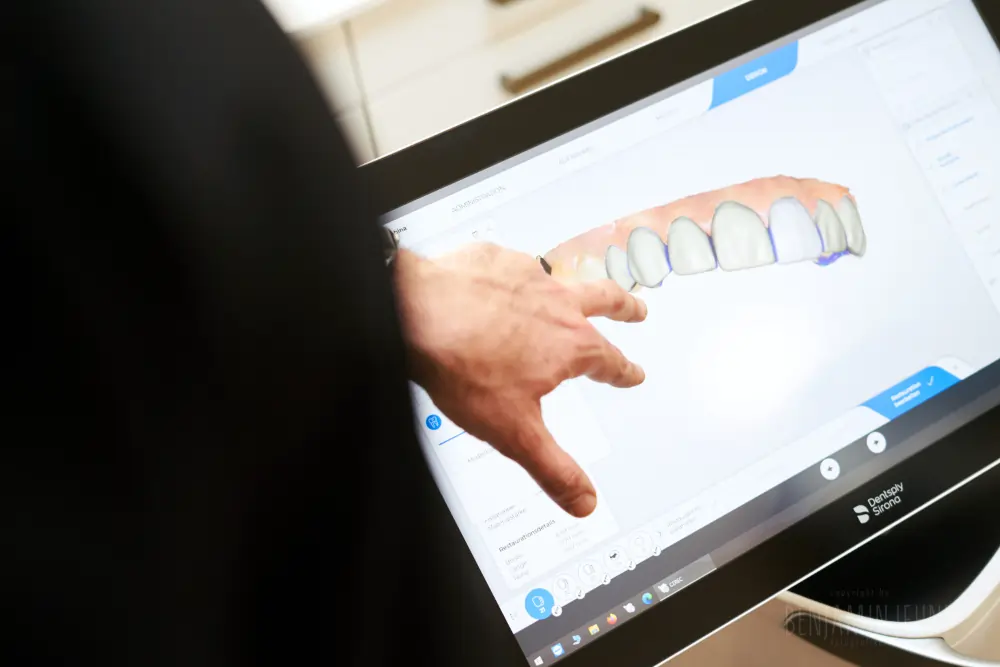 Kosten und Finanzierung für Veneers
