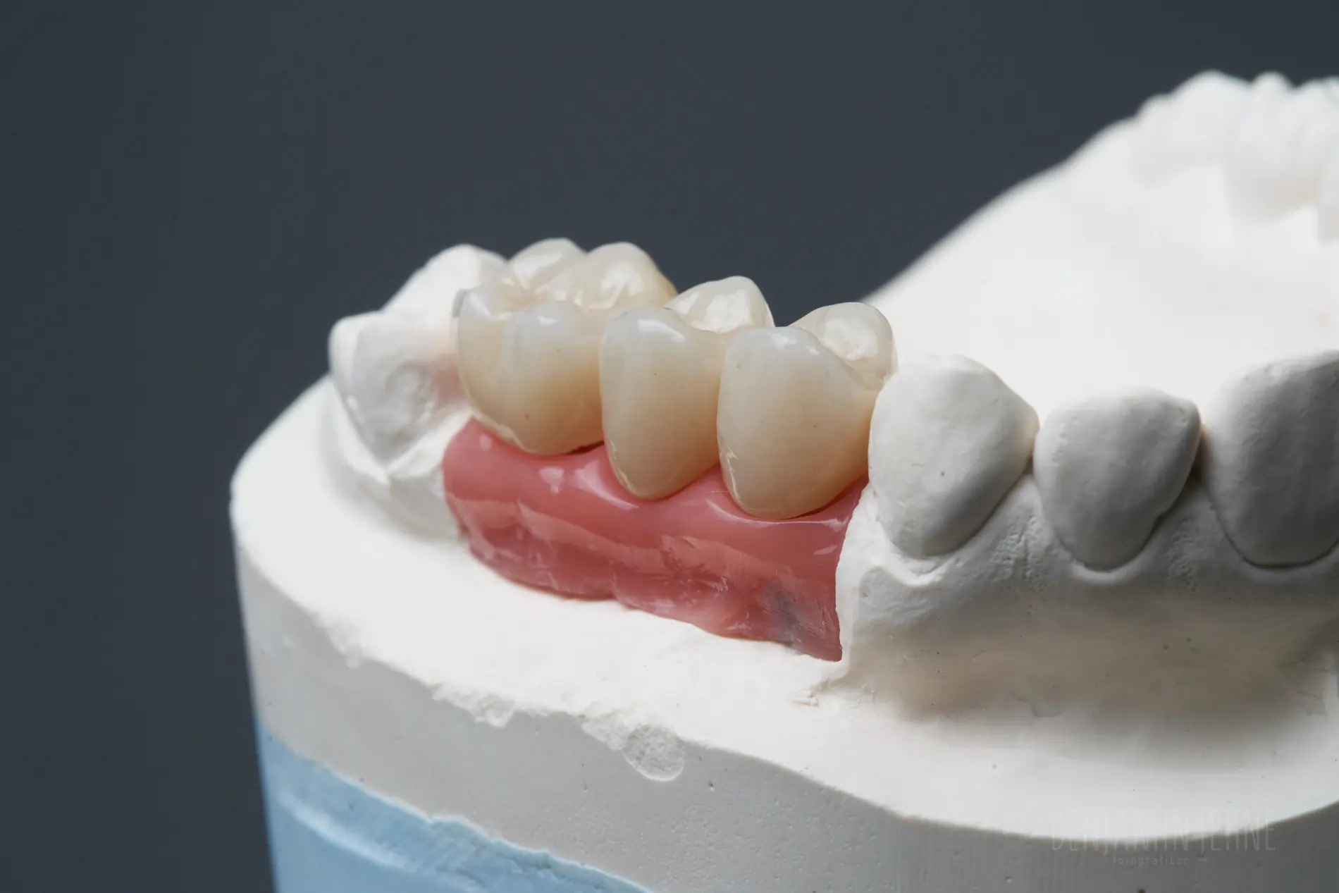 Hergestellte Implantate von Dentallabor