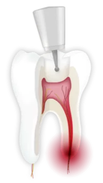 Endodontie | Zahn wird geöffnet