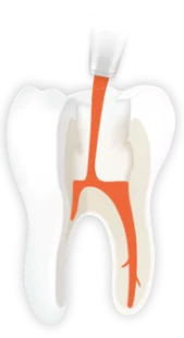 Endodontie | Füllung des Wurzelkanals