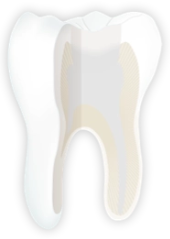 Endodontie | Der Zahn wird mit einer Kunststofffüllung verschlossen