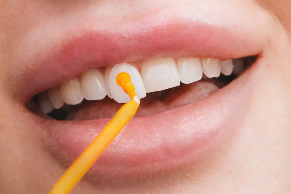 Veneers